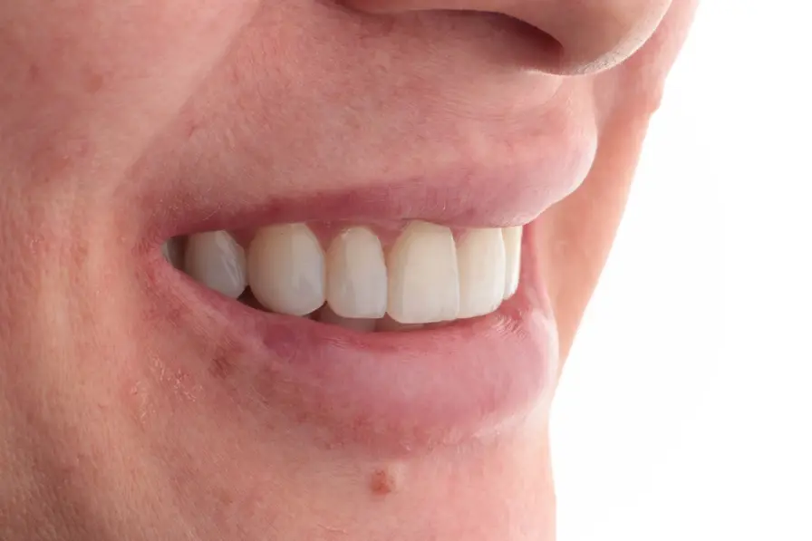 Facetas em Resina & Clareamento